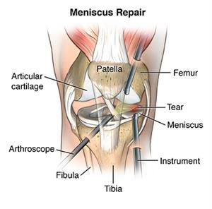 Meniscus Tears: Why You Should Not Let Them Go Untreated