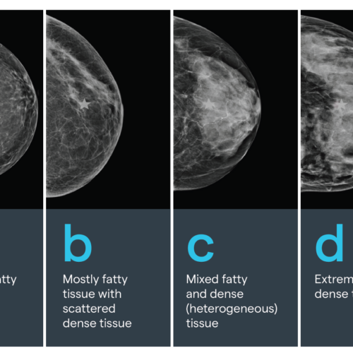 New Law Expands Insurance for 3D Mammography, Dense Breasts | Kettering ...