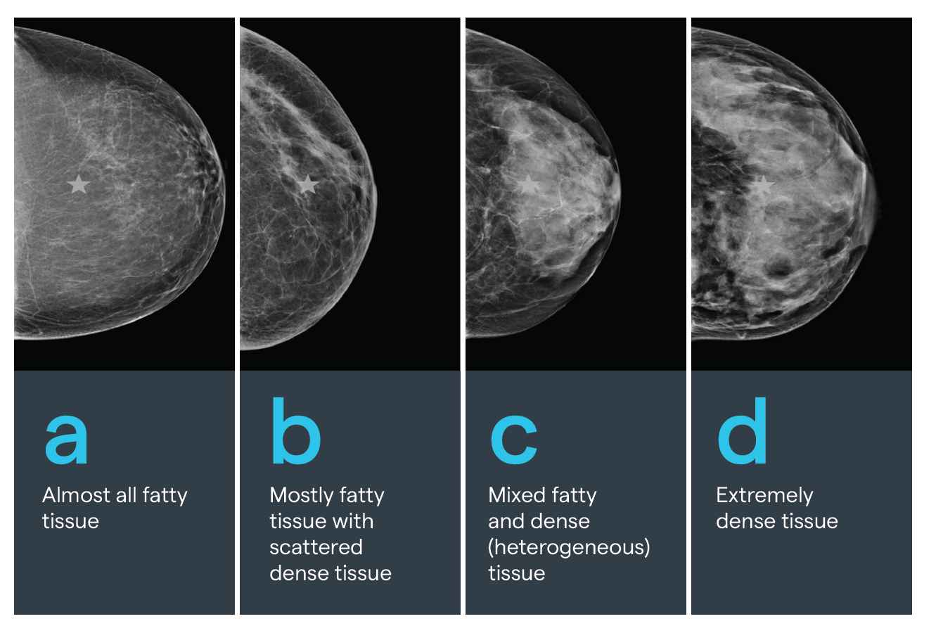 dense-breast-tissue-kettering-health